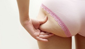 mujer con celulitis