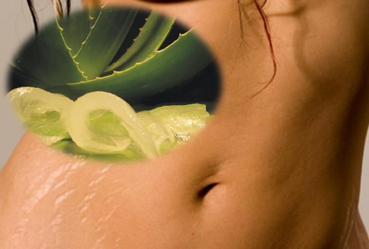 Aloe Vera para reducir las estrías